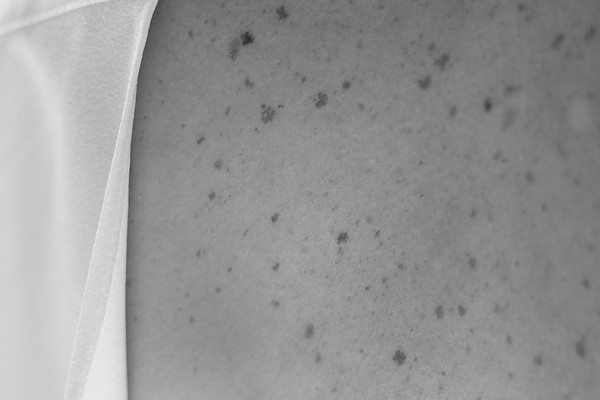 Haut mit Muttermalen – Muttermal- und Tumorvorsorge