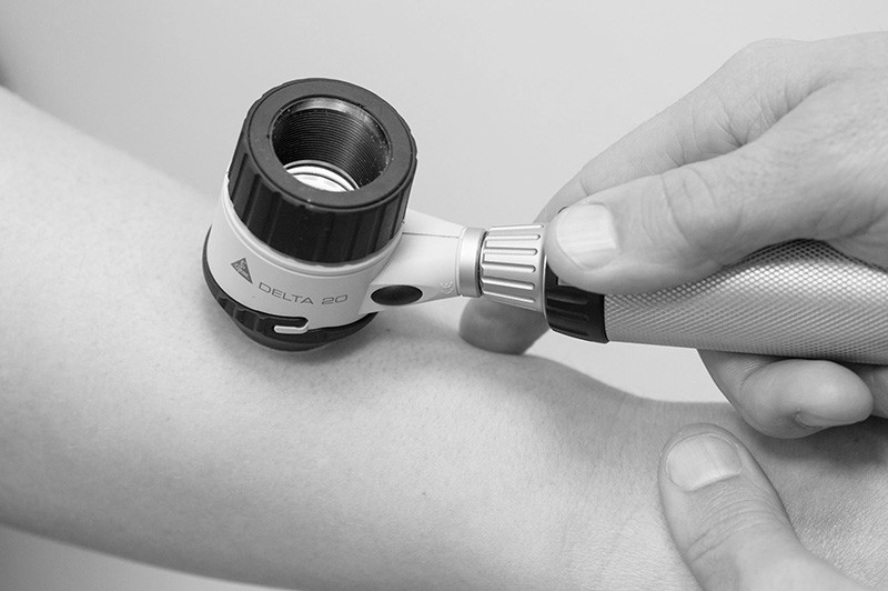 Auflichtmikroskopie – Untersuchung von Muttermalen mit dem Dermatoskop